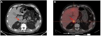 Isolated Pheochromocytoma in a 73-Year-Old Man With No Clinical Manifestations of Type 1 Neurofibromatosis Carrying an Unsuspected Deletion of the Entire NF1 Gene